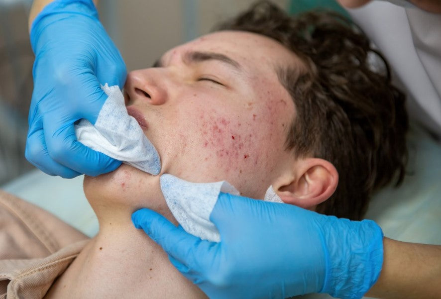 How to Prevent Acne Scars: Tips for Men